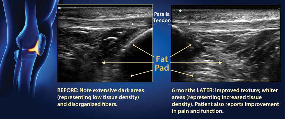 Two ultrasound image comparisons of the Knee Infrapatellar Fat Pad Before and after Biocellular Prolotherapy (adipose derived)