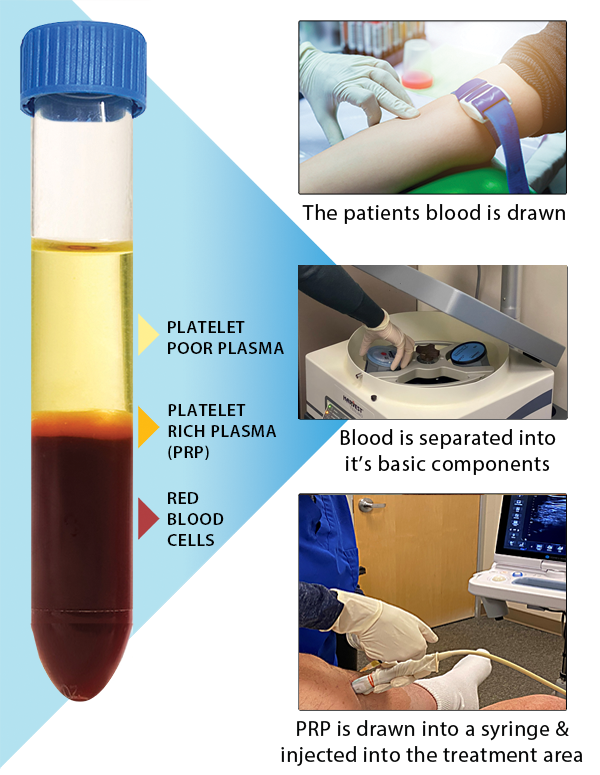 Blood being drawn and processed in a centrifuge for a prp procedure