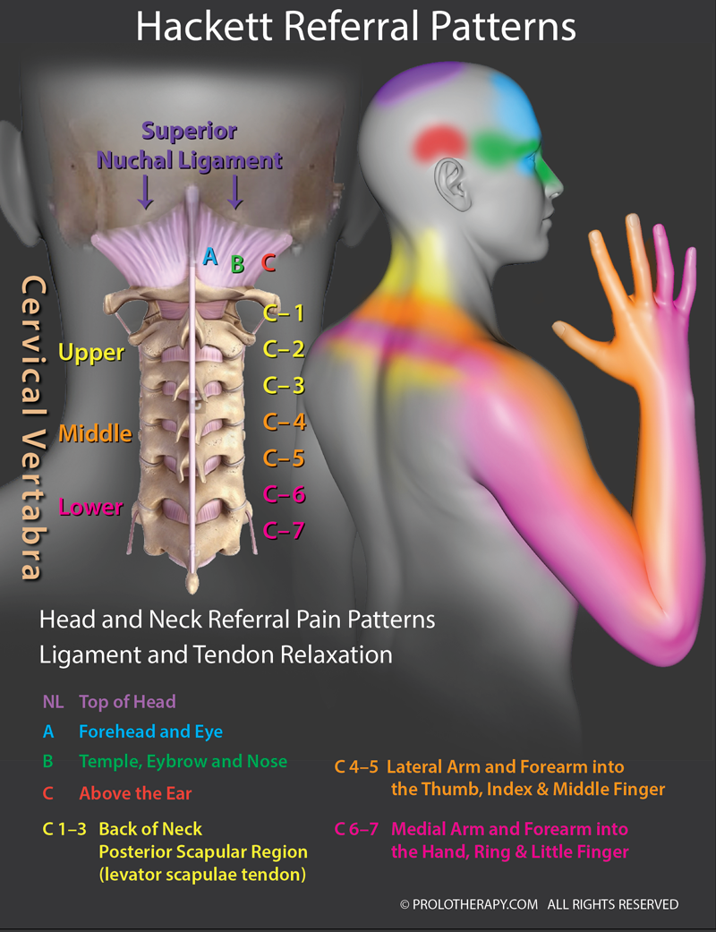 Hackett Referral Paterns of the Neck Ligaments