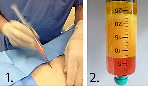 Adipose tissue (fat) being harvested by a cannula and syringe under vacuum from the abdomen.
