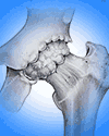 osteopytes on a hip joint before prolotherapy regenerative medicne treatment