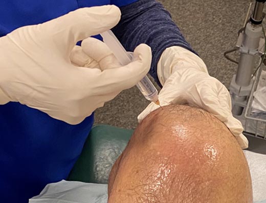 Patient receiving dextrose prolotheray knee injection