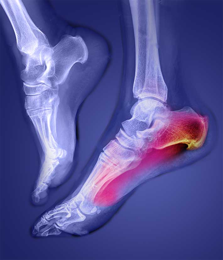 n x-ray image of a runner montaged with images showing the ligament antatomy of the knee.