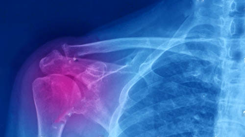 x-ray of shoulder area indicating joint pain