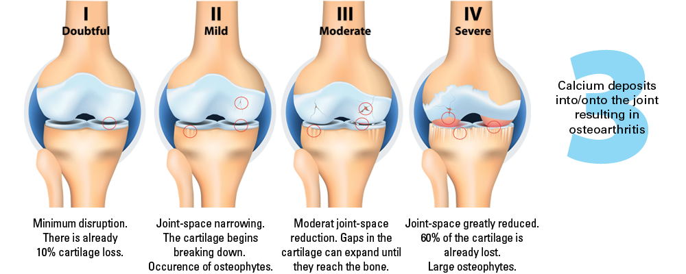The four stages of osteoarthritis