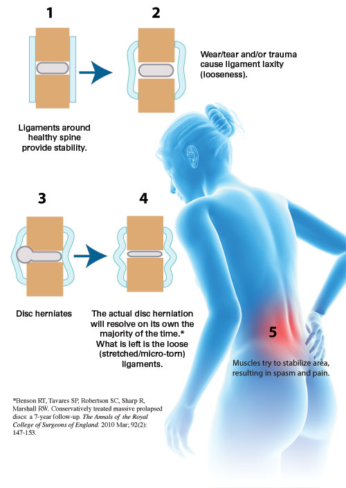 Four stages of disc herniation and a person suffering back spasm pain.