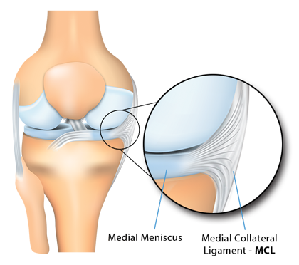 An illustration of Medial meniscus/medial collateral ligament (MCL) interface, normal anatomy