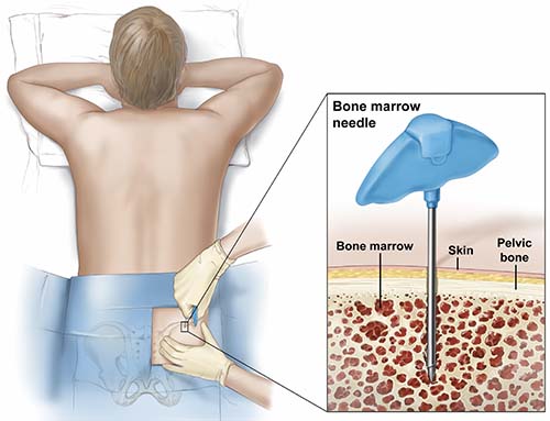 Bone marrow havesting with a bone marrow needle.