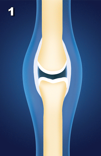 Animation showing how ligament laxity can lead to osteoarthritis.