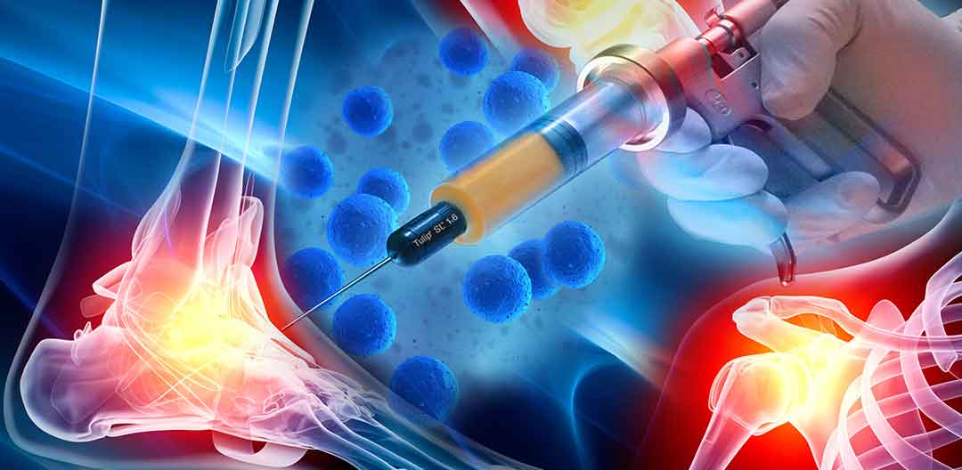 Biocellular Stem-Cell Rich Prolotherapy treatment of arthritic joints