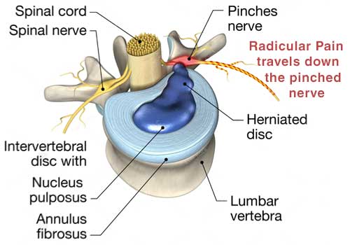 herniated disc causing nerve pain
